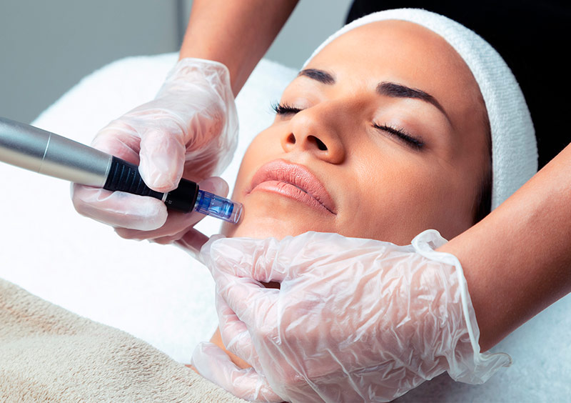 microneedling-Beautyqueen-Chur